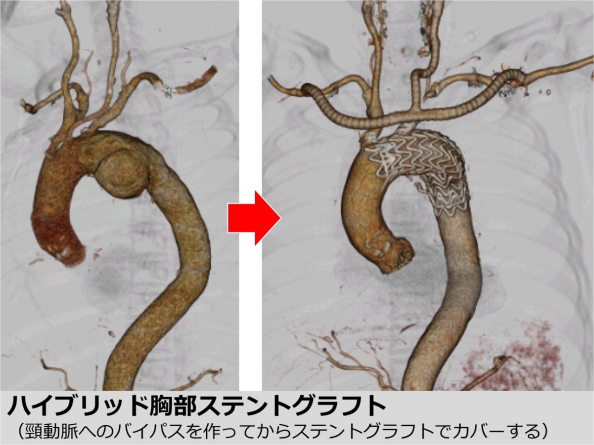 胸部大動脈瘤に対する治療について | 東京大学血管外科