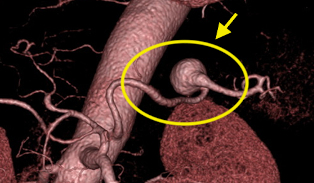 Treatment of splenic artery aneurysm | Vascular Surgery, The University ...