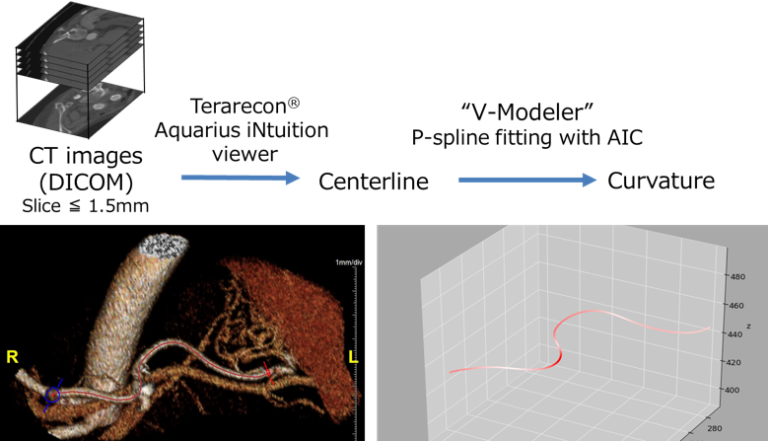 Treatment of splenic artery aneurysm | Vascular Surgery, The University ...