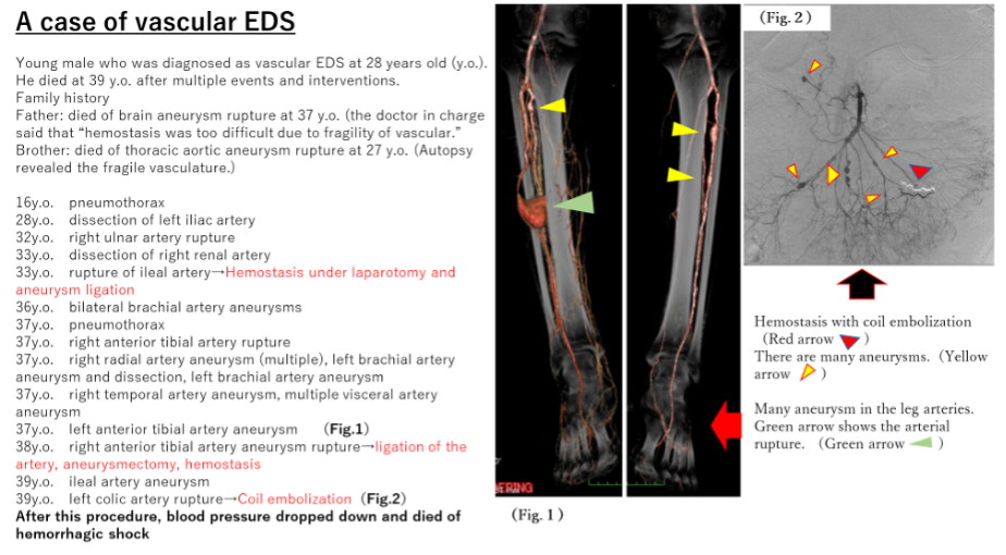 Vascular Ehlers Danlos Syndrome VASCERN The ERN On Rare Multisystemic
