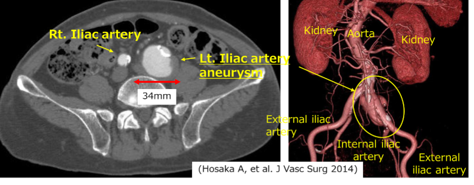 right common iliac artery